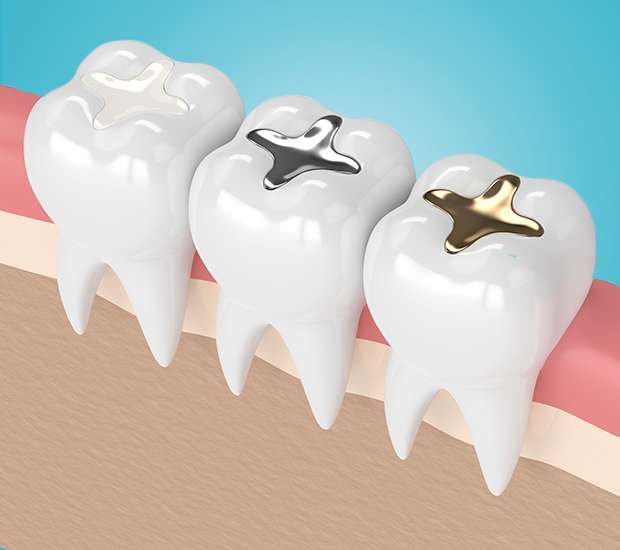 Cranford Composite Fillings