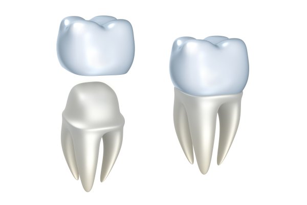 Common Dental Crown Solutions