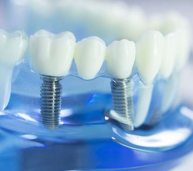 Cranford Dental Implants