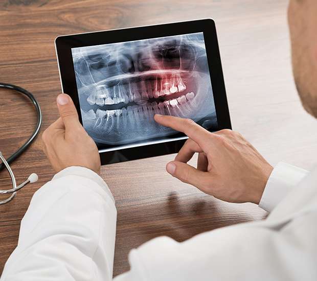 Cranford Types of Dental Root Fractures