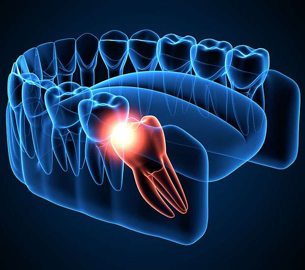 Cranford Wisdom Teeth Extraction